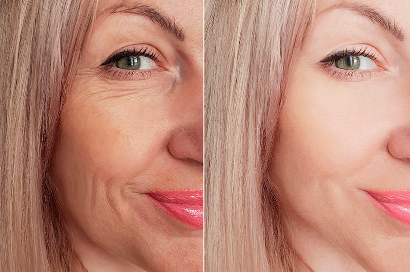 Hialur&oacute;nico monof&aacute;sico con lidocaina Singderm&reg;